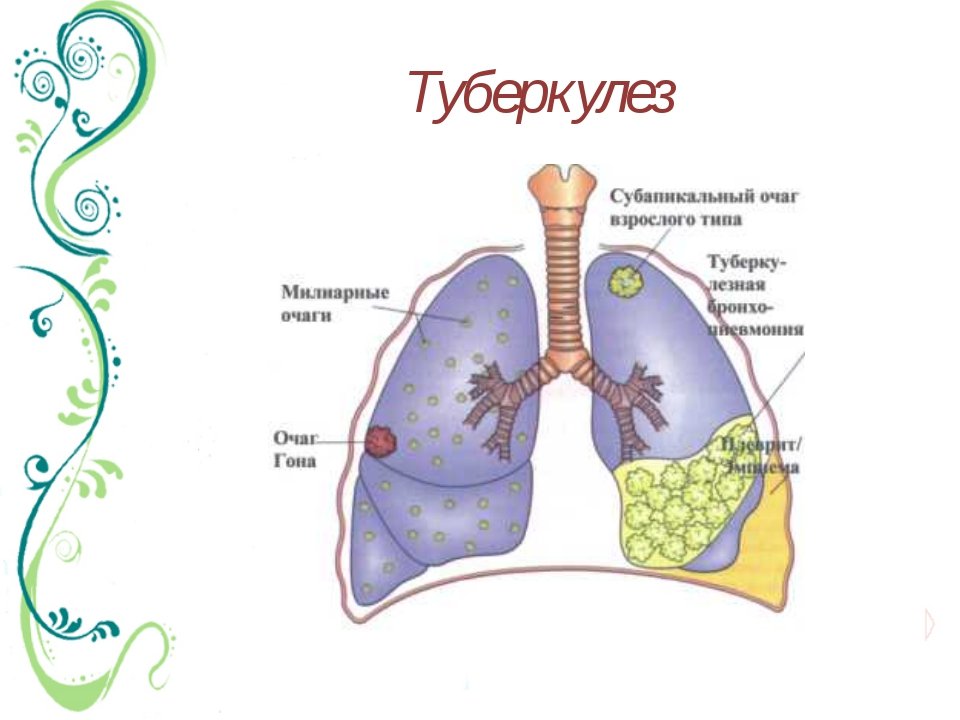 Первичный туберкулез картинки